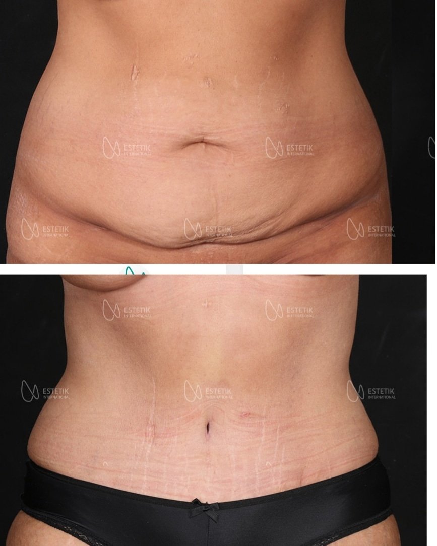 Before and after result by Dr. Selçuk Aytaç