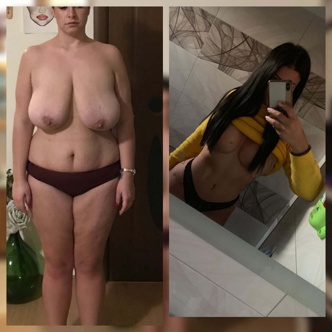 Before and after result by Dr. Selçuk Aytaç