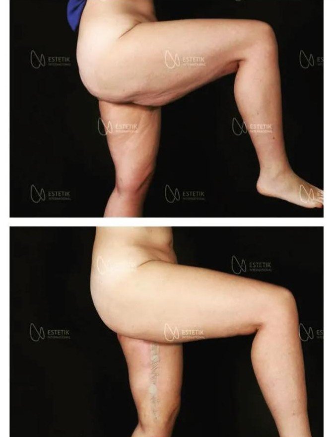 Before and after result by Dr. Selçuk Aytaç