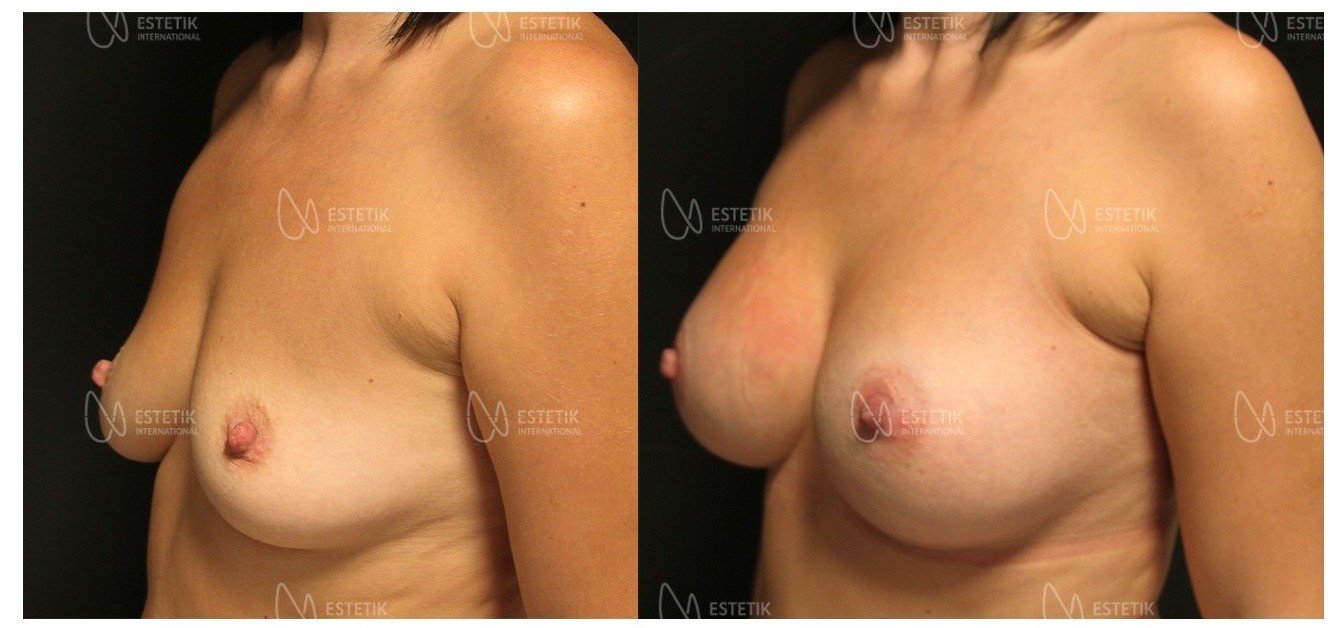 Before and after result by Dr. Selçuk Aytaç