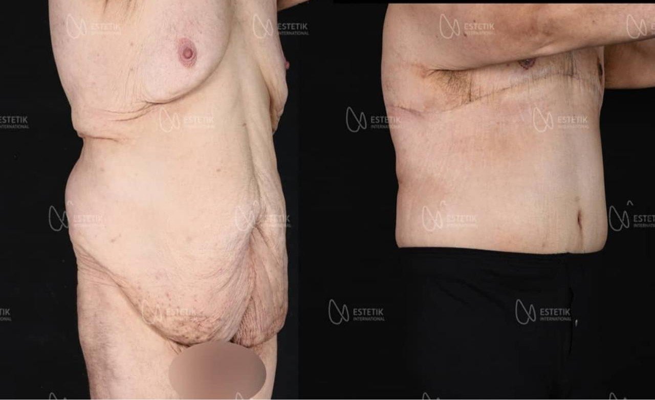 Before and after result by Dr. Selçuk Aytaç
