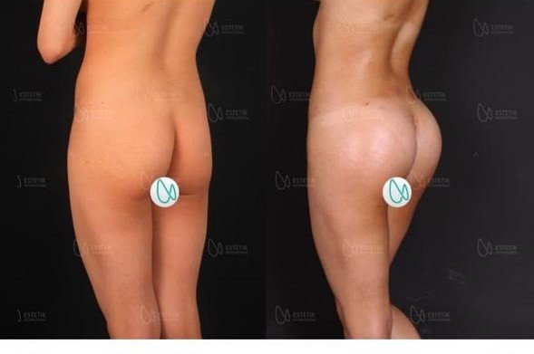 Before and after result by Dr. Selçuk Aytaç