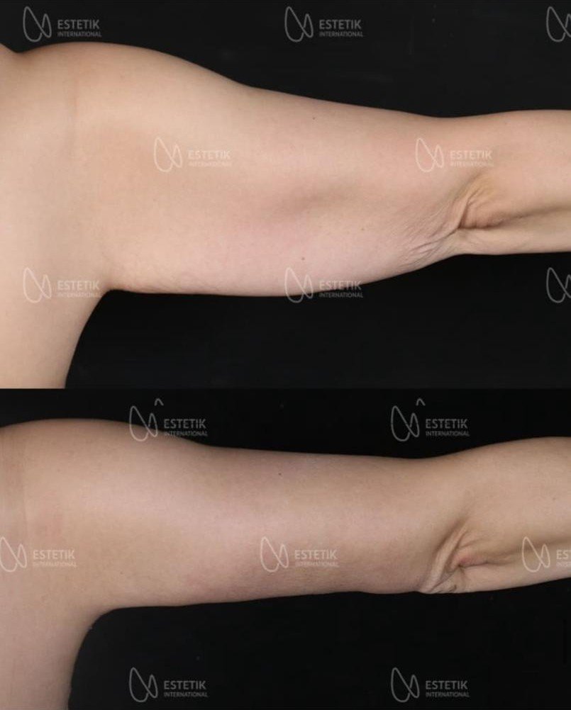 Before and after result by Dr. Selçuk Aytaç