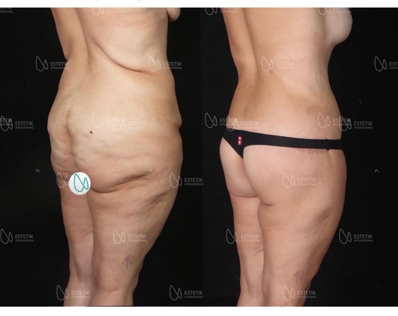 Before and after result by Dr. Selçuk Aytaç