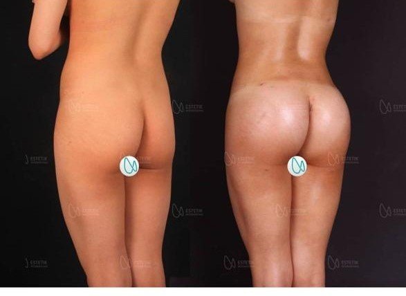 Before and after result by Dr. Selçuk Aytaç