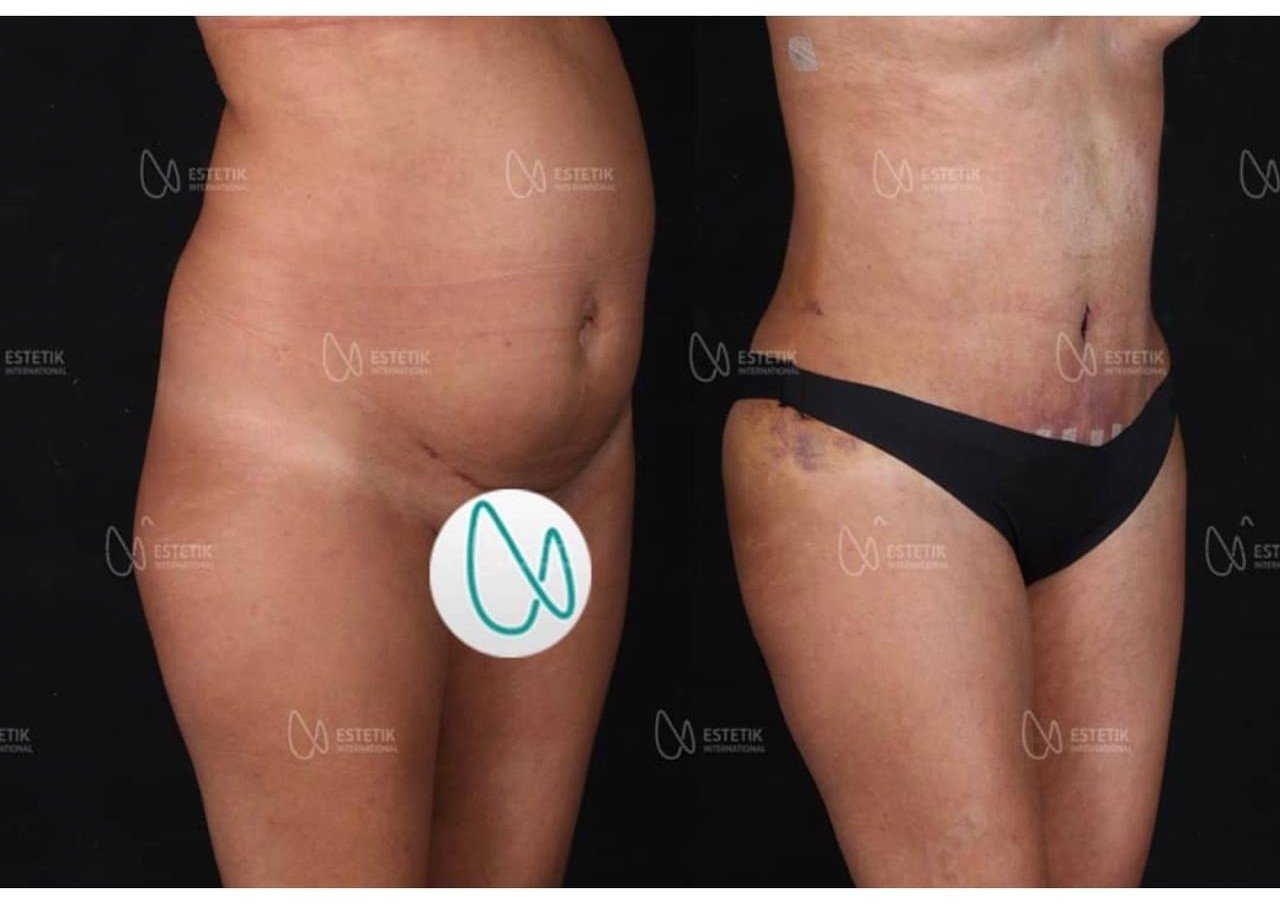 Before and after result by Dr. Selçuk Aytaç