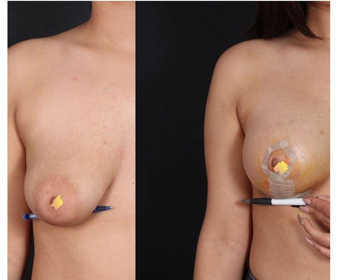 Before and after result by Dr. Selçuk Aytaç