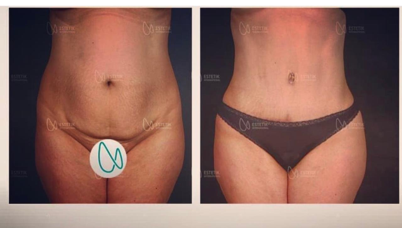 Before and after result by Dr. Selçuk Aytaç