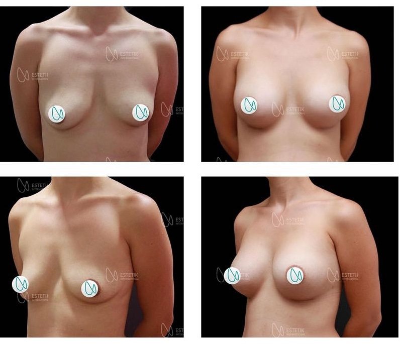 Before and after result by Dr. Selçuk Aytaç