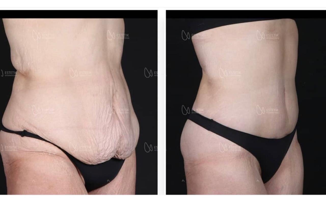 Before and after result by Dr. Selçuk Aytaç