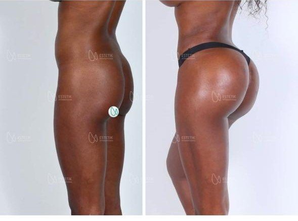Before and after result by Dr. Selçuk Aytaç