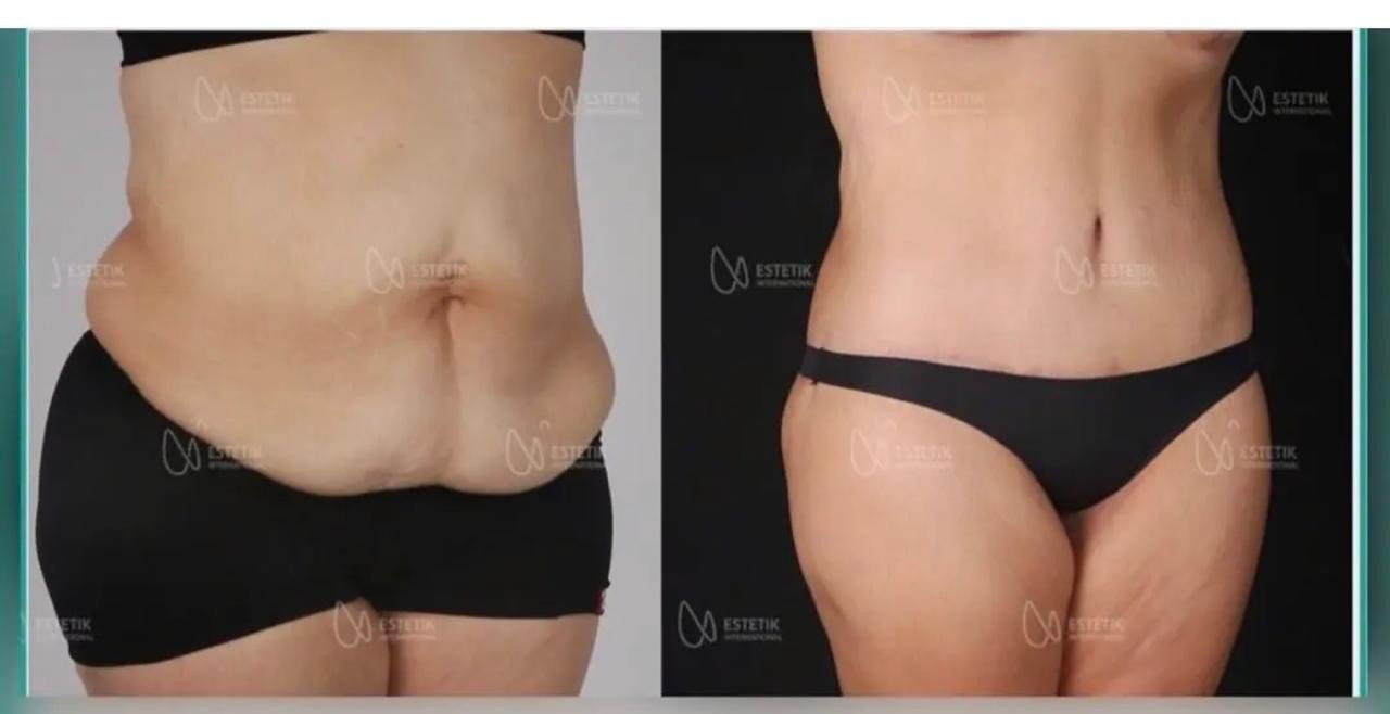 Before and after result by Dr. Selçuk Aytaç