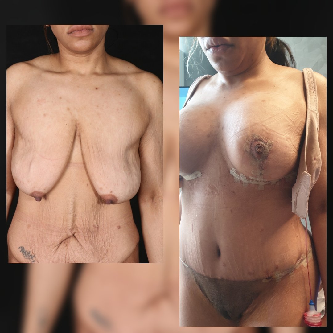 Before and after result by Dr. Selçuk Aytaç