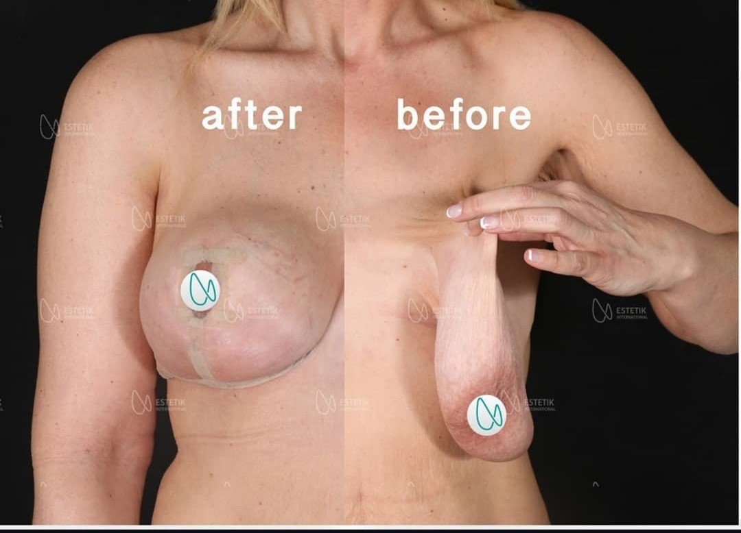 Before and after result by Dr. Selçuk Aytaç