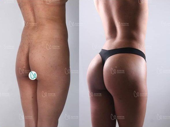 Before and after result by Dr. Selçuk Aytaç