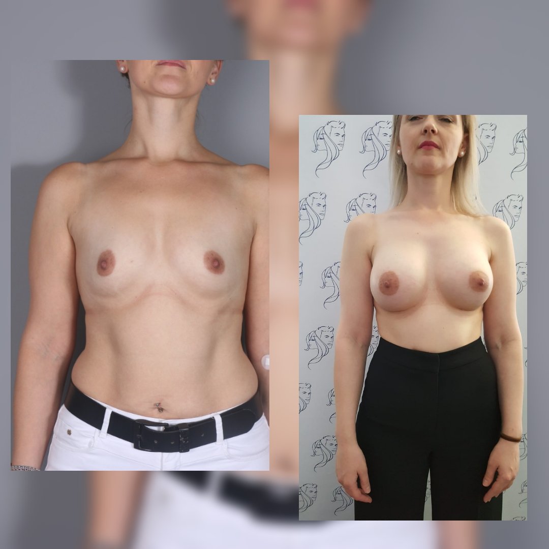 Before and after result by Dr. Selçuk Aytaç