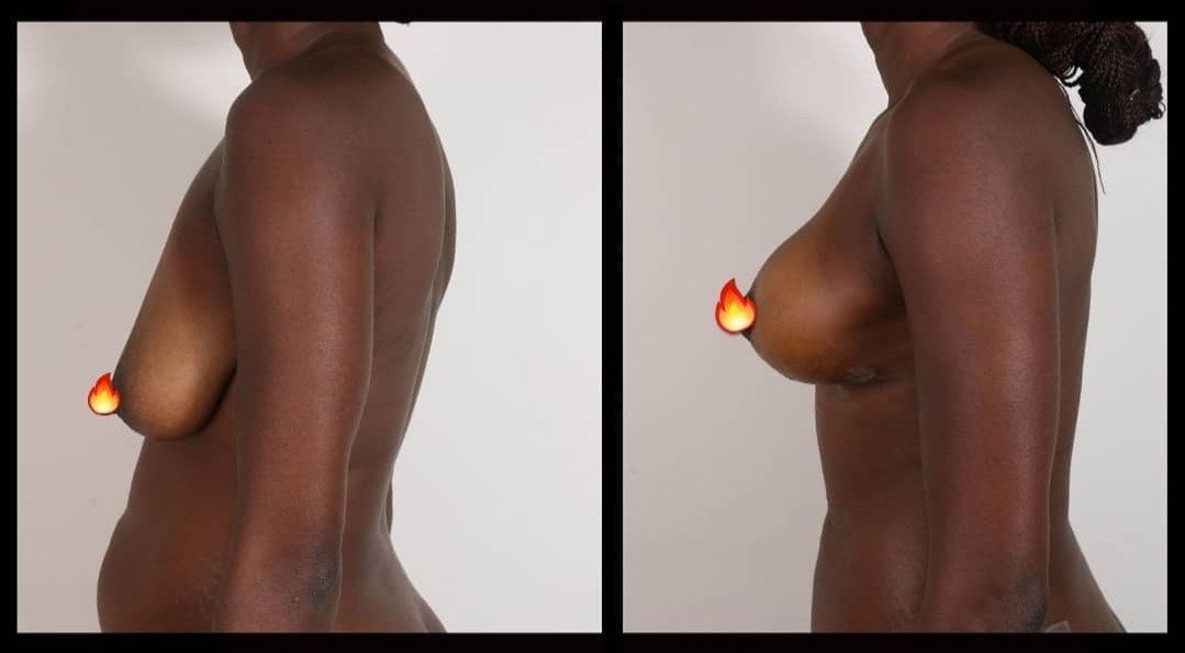 Before and after result by Dr. Selçuk Aytaç