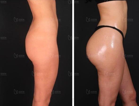 Before and after result by Dr. Selçuk Aytaç