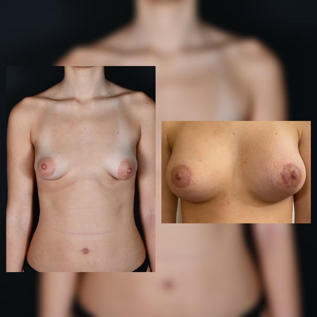 Before and after result by Dr. Selçuk Aytaç
