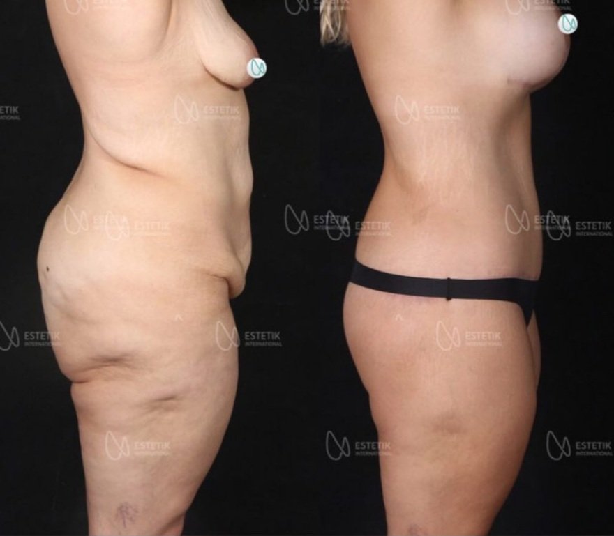 Before and after result by Dr. Selçuk Aytaç