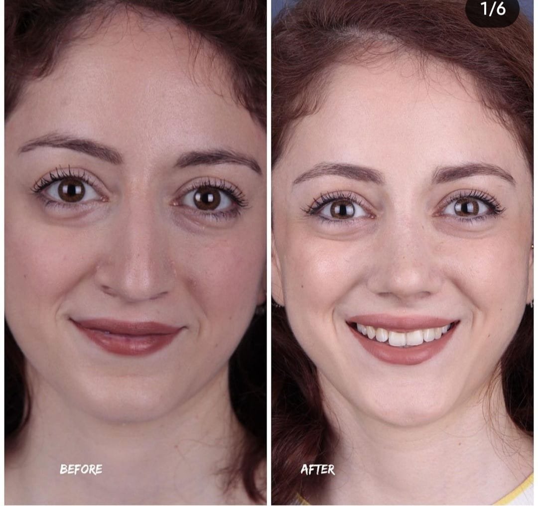 Before and after result by Dr. Yavuz Selim Yıldırım