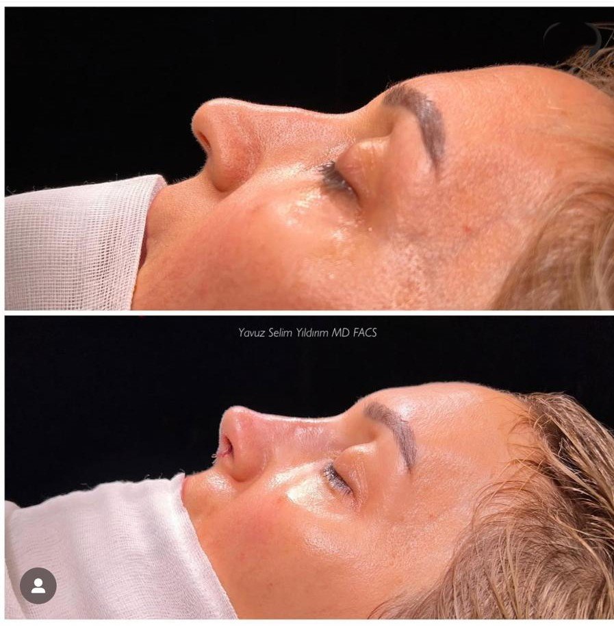 Before and after result by Dr. Yavuz Selim Yıldırım