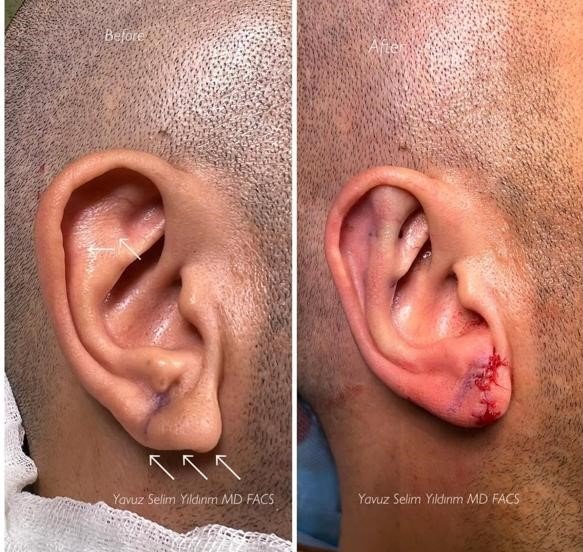 Before and after result by Dr. Yavuz Selim Yıldırım