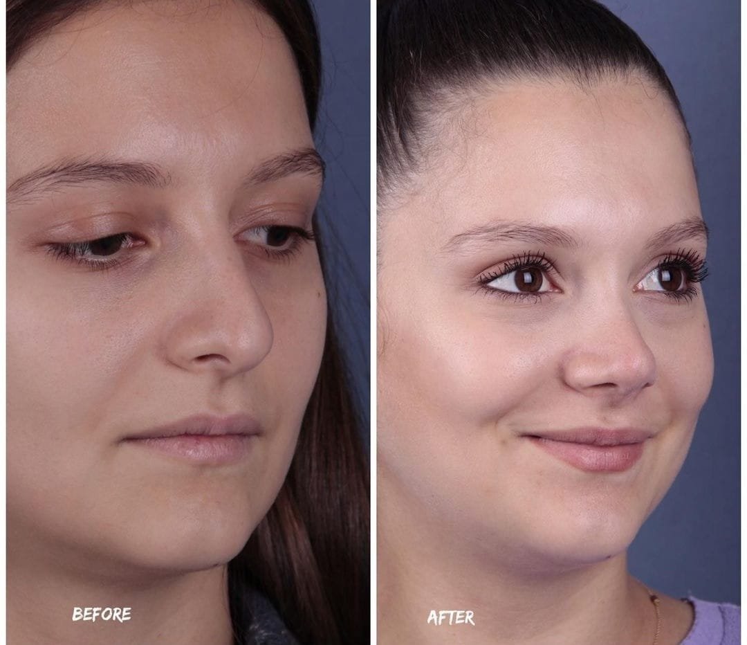 Before and after result by Dr. Yavuz Selim Yıldırım