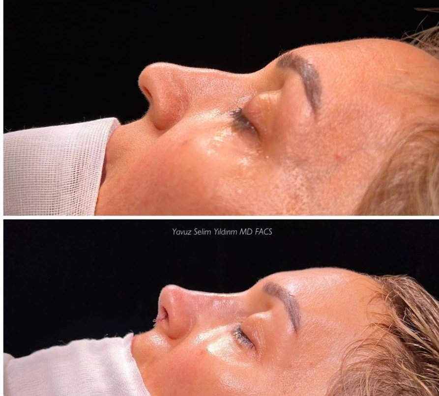 Before and after result by Dr. Yavuz Selim Yıldırım