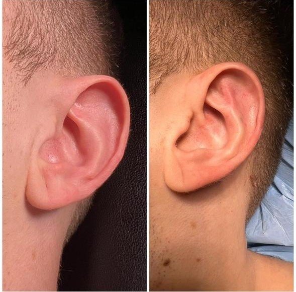 Before and after result by Dr. Yavuz Selim Yıldırım