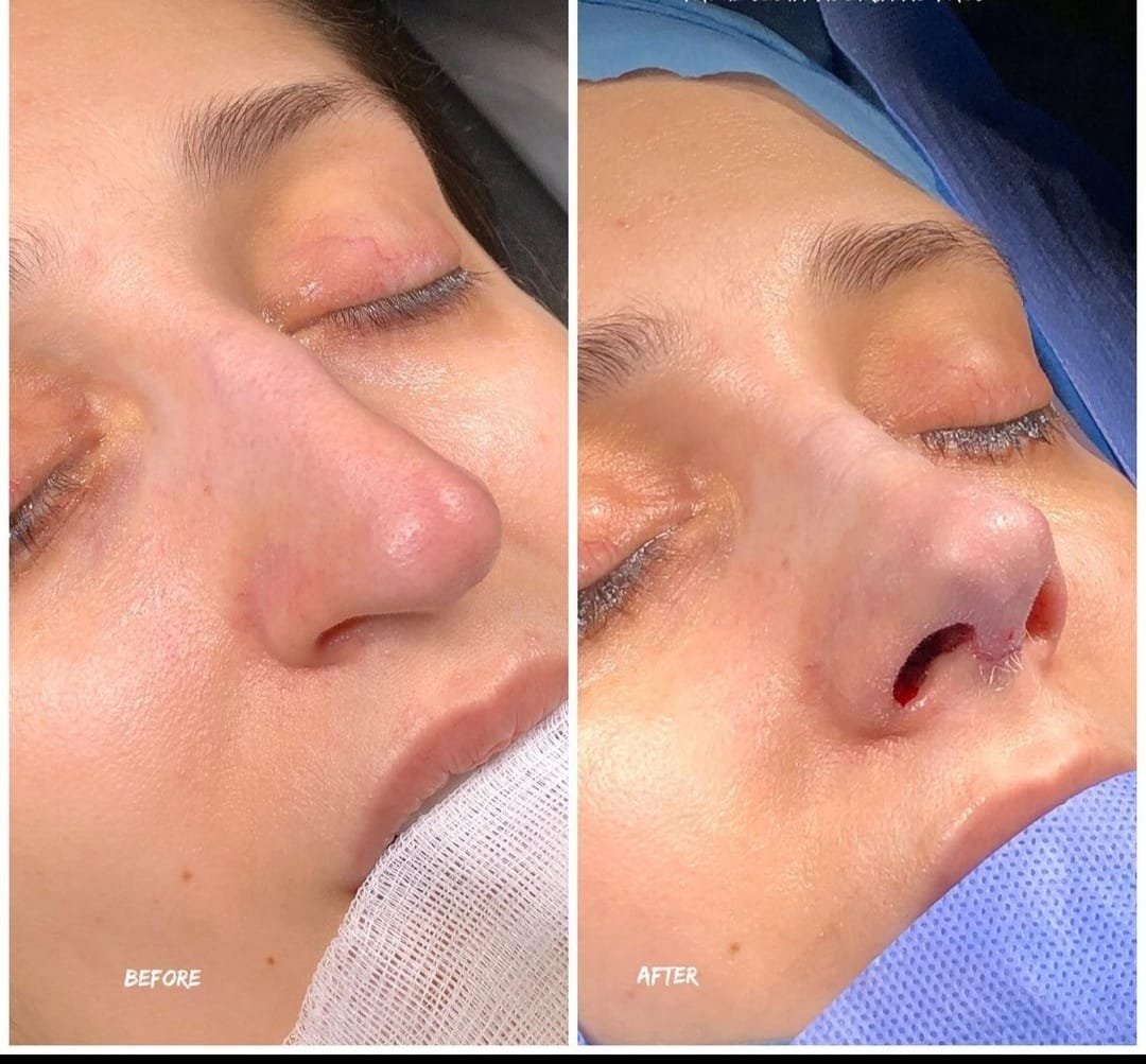 Before and after result by Dr. Yavuz Selim Yıldırım