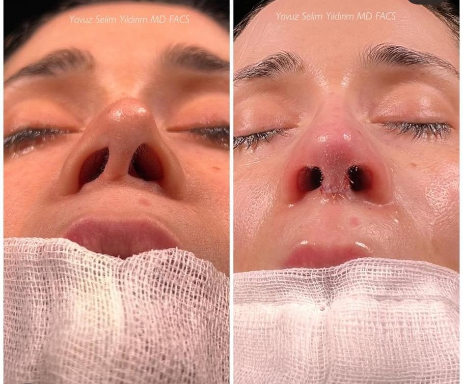 Before and after result by Dr. Yavuz Selim Yıldırım