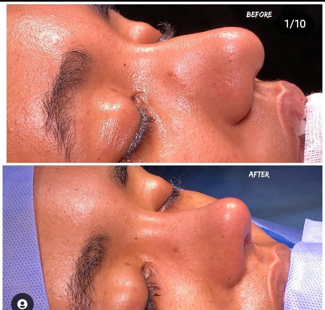 Before and after result by Dr. Yavuz Selim Yıldırım