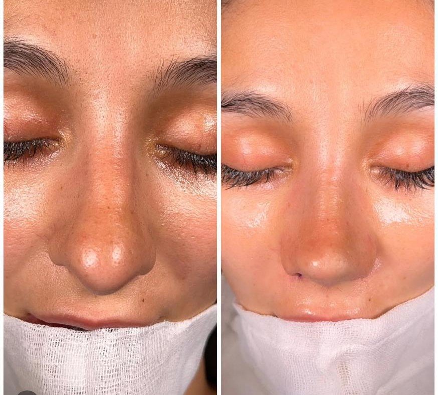 Before and after result by Dr. Yavuz Selim Yıldırım