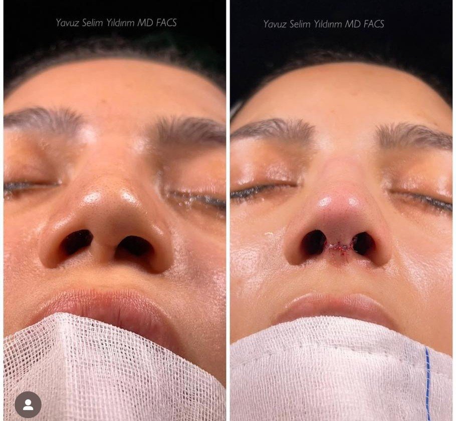 Before and after result by Dr. Yavuz Selim Yıldırım