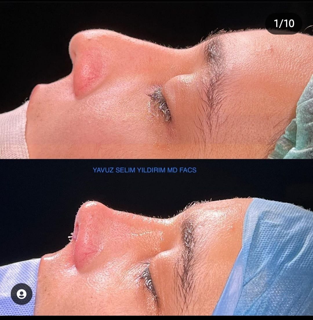 Before and after result by Dr. Yavuz Selim Yıldırım