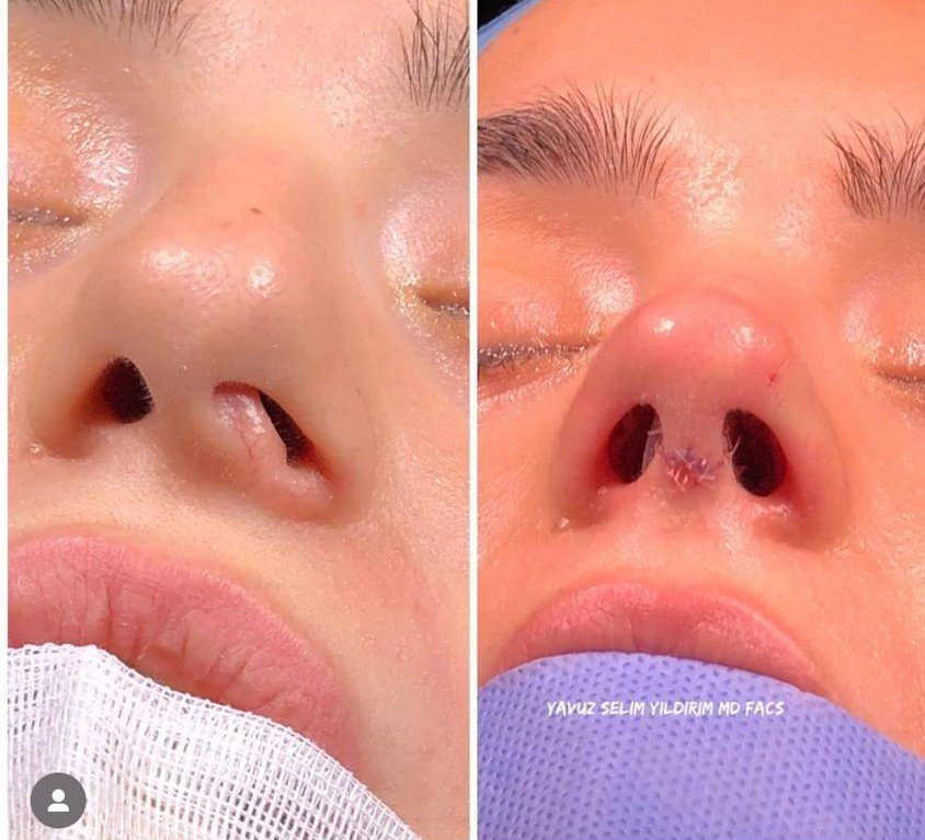 Before and after result by Dr. Yavuz Selim Yıldırım