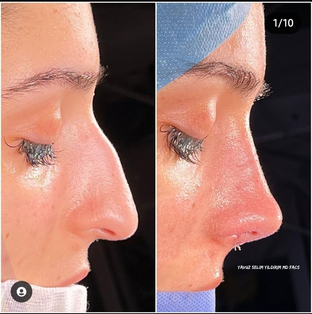 Before and after result by Dr. Yavuz Selim Yıldırım