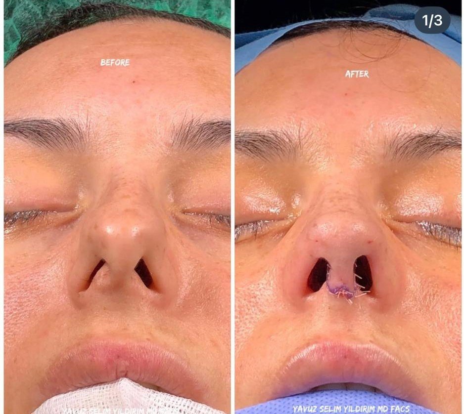 Before and after result by Dr. Yavuz Selim Yıldırım