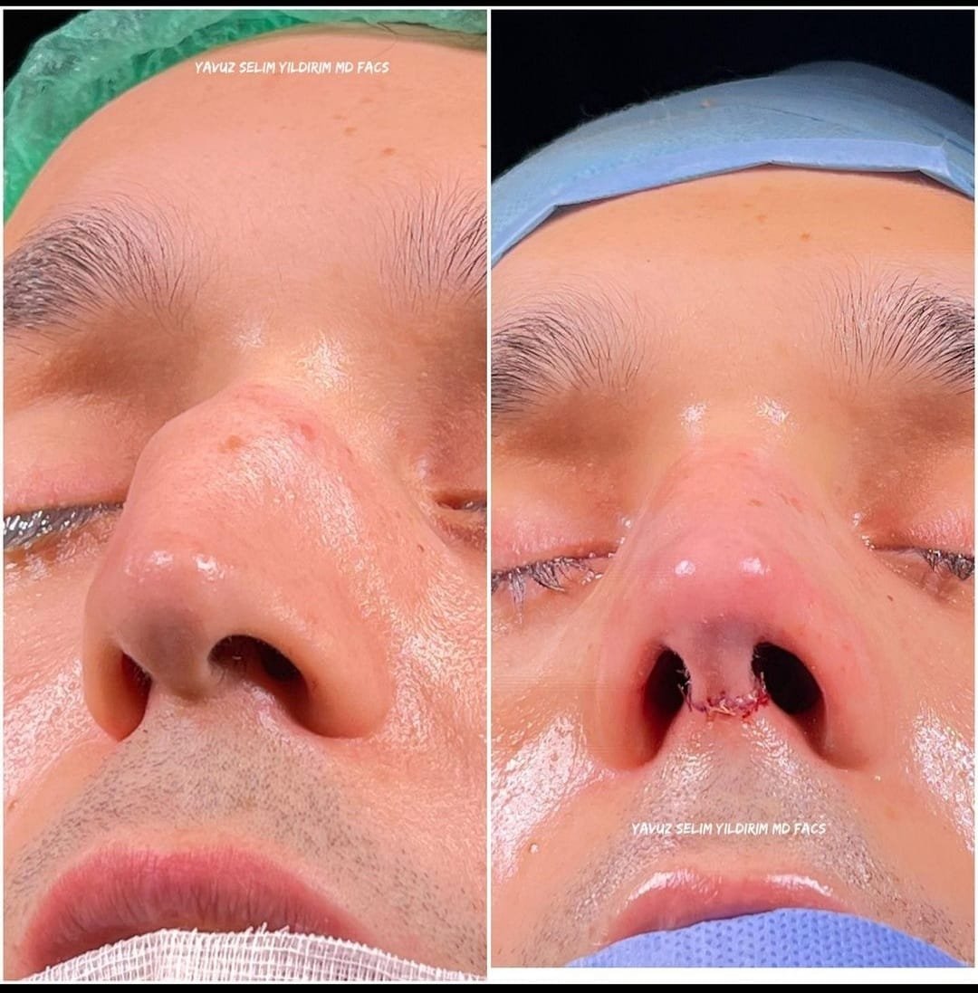 Before and after result by Dr. Yavuz Selim Yıldırım