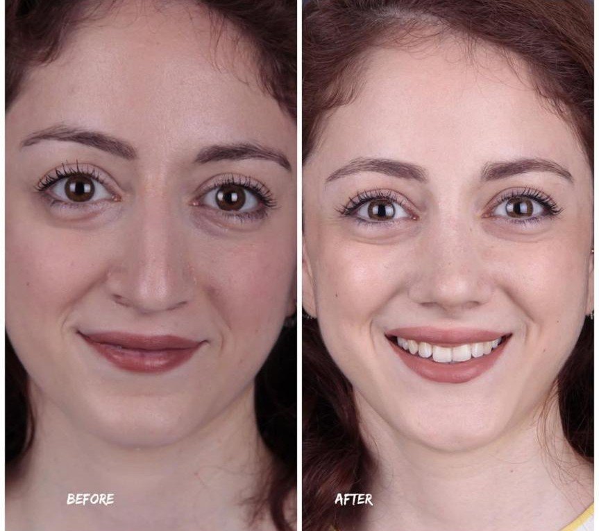 Before and after result by Dr. Yavuz Selim Yıldırım