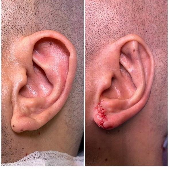 Before and after result by Dr. Yavuz Selim Yıldırım