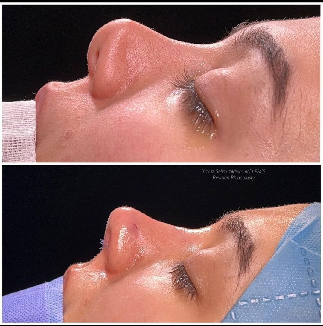 Before and after result by Dr. Yavuz Selim Yıldırım