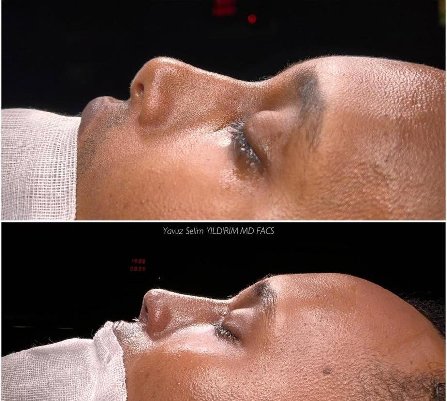 Before and after result by Dr. Yavuz Selim Yıldırım