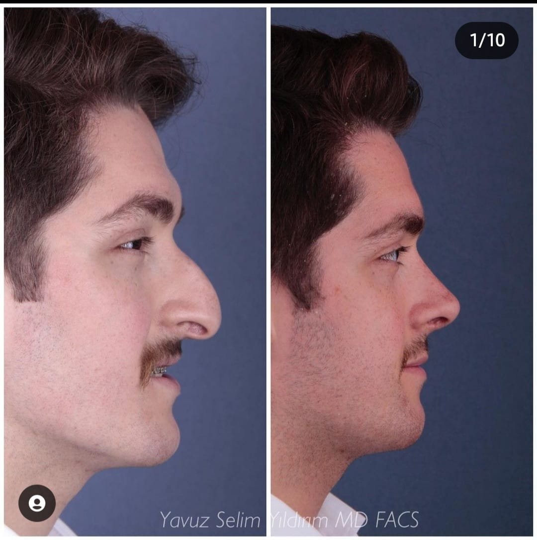 Before and after result by Dr. Yavuz Selim Yıldırım