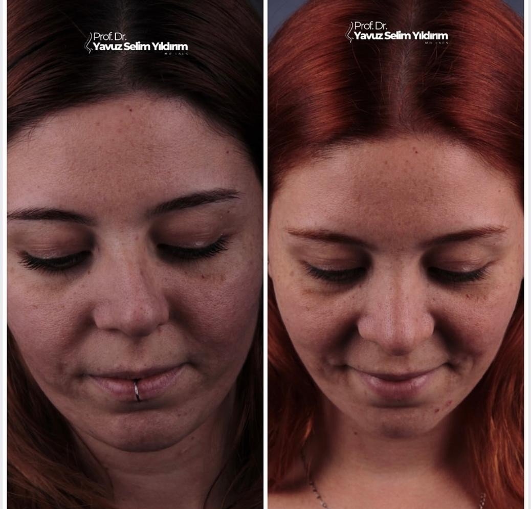 Before and after result by Dr. Yavuz Selim Yıldırım