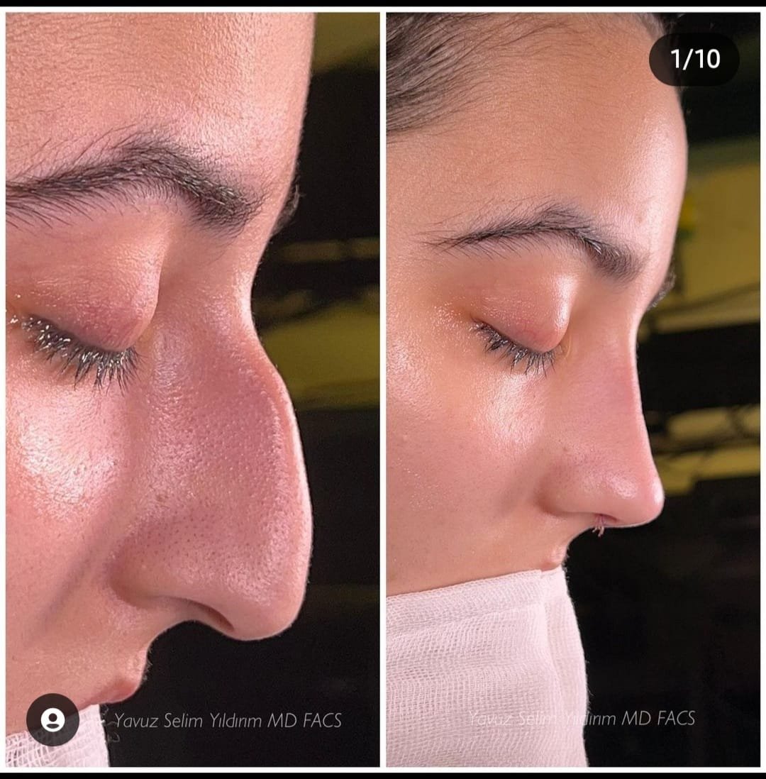 Before and after result by Dr. Yavuz Selim Yıldırım