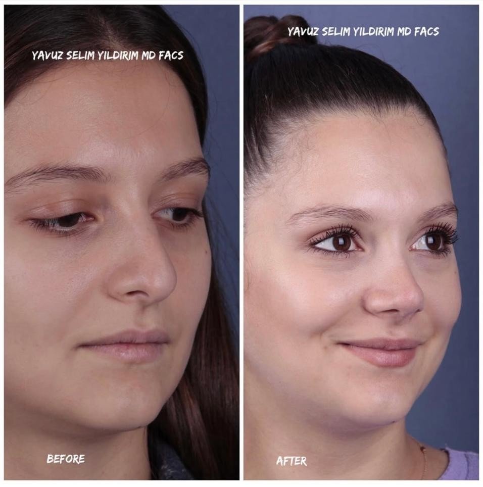 Before and after result by Dr. Yavuz Selim Yıldırım