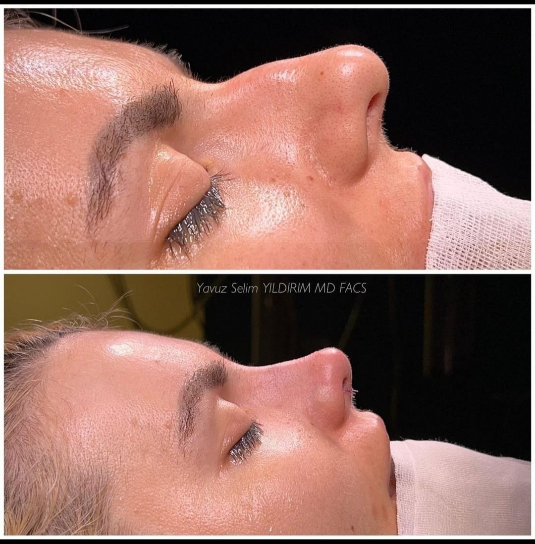 Before and after result by Dr. Yavuz Selim Yıldırım