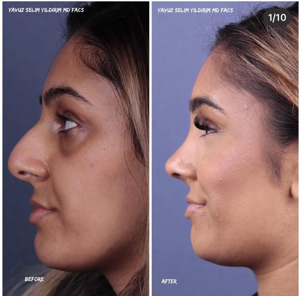 Before and after result by Dr. Yavuz Selim Yıldırım